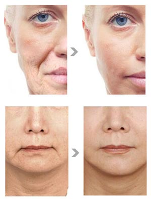 HIFU | Esprit Zen — Le Lifting sans Chirurgie