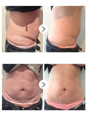 HIFU | Esprit Zen — Le Lifting sans Chirurgie